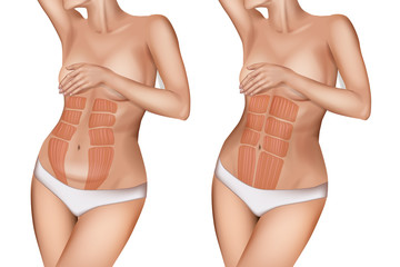 Diastasis recti or rectus abdominis diastasis