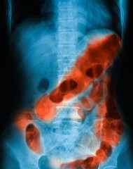 X-ray image of abdomen pain, supine position, showing Ulcerative Colitis (UC) and Peptic ulcer perforate