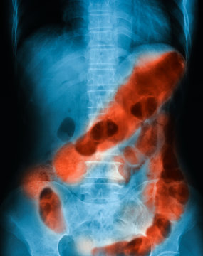 X-ray image of abdomen pain, supine position, showing Ulcerative Colitis (UC) and Peptic ulcer perforate