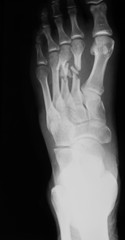 X-ray image of left foot, oblique view, showing metatarsal bone fractures