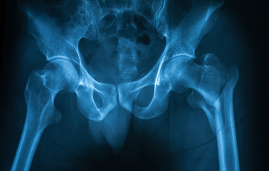 X-ray image of the both hip showing right femoral neck fracture