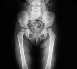 X-ray image of pelvic and bladder showing cystitis or lower urinary tract infection