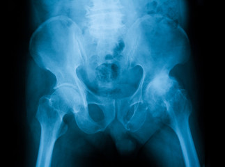 X-ray image of pelvic and hip joint showing left hip Osteoarthritis: OA