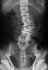 X-ray image of lumbo-sacral spine (L-S spine) showing lumbar spondylosis disease, AP view.