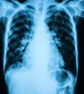 Chest X-ray image showing Pulmonary tuberculosis