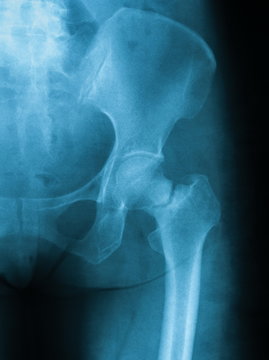 X-ray image of hip joint antero posterior view, showing femoral neck fracture.