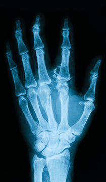 X-ray image of broken hand, anteroposterior (AP) view, showing metacarpal bone