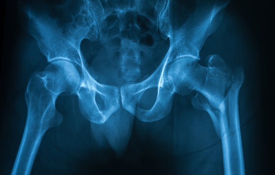 X-ray image of the both hip showing right femoral neck fracture