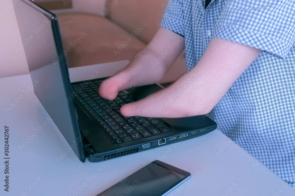 Wall mural Disabled man with amputated two stump hands works typing on laptop closeup view. Handicapped man office work at table. Independent Invalid freelancer person. Adaptation to life man wit disabilities.