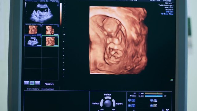 Computer screen with an ultrasound image of a fetus