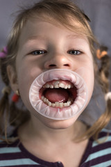 Adult permanent teeth coming in front of the child's baby teeth: shark teeth.