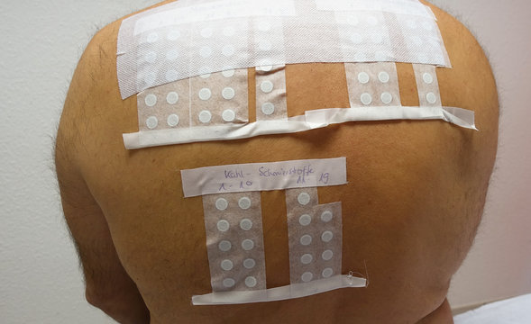 Skin Allergy Patch Test on Back of Male Patient. German inscription translation: Kühl- und Schmierstoffe - Cool and lubricants substance. Real photo.                           