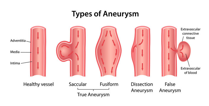 Types of aneurysm: True Aneurysm (Saccular, Fusiform), False Aneurysm and Dissection Aneurysm. Longitudinal section of blood vessels indicating blood flow. Vector illustration in flat style