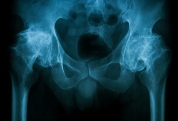 X-ray image of both hip, AP view, Showing both hip osteoarthritis (Degenerative arthritis of the hip)