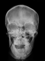 X-ray image of skull, anteroposterior (AP) view, showing mandibura fracture, (fracture of the jaw)