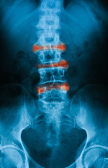 X-ray image of lumbosacral spine, anteroposterior (AP) view, show ankylosing spondylitis lumbar - obrazy, fototapety, plakaty