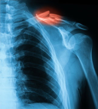 X-ray image of clavicle, AP view., showing clavicle fracture