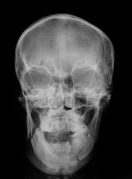 X-ray image of skull, anteroposterior (AP) view, showing mandibura fracture, (fracture of the jaw)