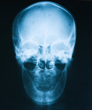 X-ray image of skull, a man loss of teeth, old man