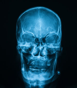 X-ray image of human skull, car accident