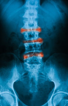X-ray image of lumbosacral spine, anteroposterior (AP) view, show ankylosing spondylitis lumbar