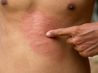 Skin Scratching an itch . Sensitive Skin, Food allergy symptoms, Irritation.