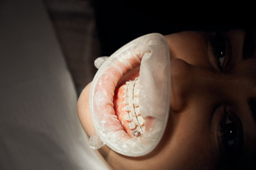Obraz premium Mouth of patient with braces and mouth retractor.