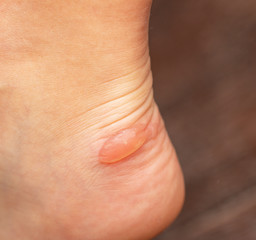 grated blown callus on the foot on the skin