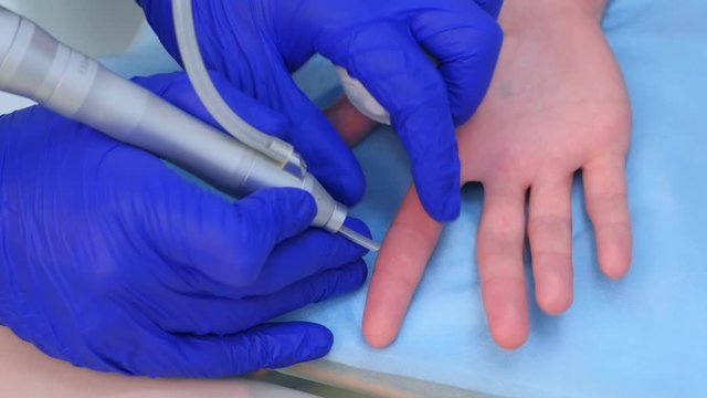 Surgeon removing wart on finger using laser, hands closeup. Remove verruca on hand finger. One day surgery concept. Cosmetic treatment.