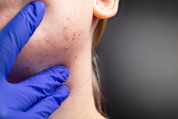 Acne on the chin: demodecosis tick on the skin of a girl's face. Patient at the appointment of a dermatologist. Problem skin and beauty concept.