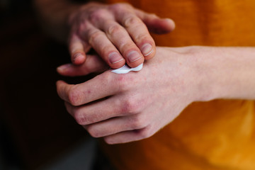 Ointment on the hands of an elderly person. Retired applying the ointment , creams in the treatment of eczema, psoriasis and other skin diseases