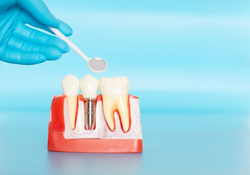 Plastic samples of dental implants compare with natural teeth.