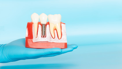 Plastic samples of dental implants compare with natural teeth.