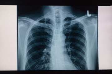 xray of human chest