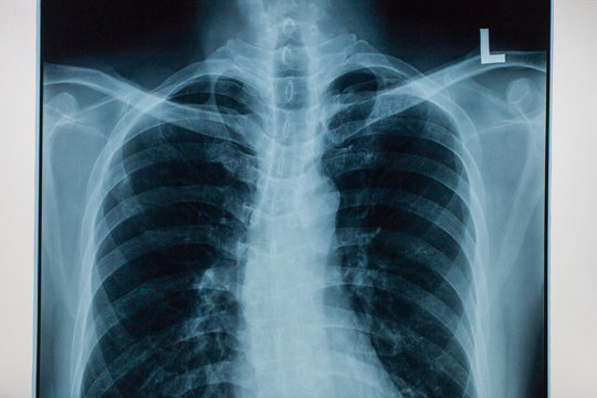 xray of a chest