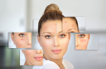 Post-Acne Marks /Treating Acne Scars.Acne Scar Removal
