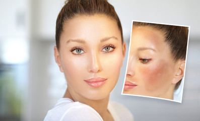 Dark spots, freckles,hyperpigmentation(melasma or chloasma)	