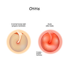 otitis. Healthy membrane, and bulging tympanic membrane of Acute otitis media - obrazy, fototapety, plakaty