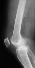 X-ray image of knee joint, lateral view, shows knee osteoarthritis (OA) 