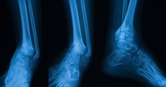 X-ray image of Ankle joint, showing osteomylitis of the calcaneum