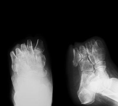 X-ray image of diabetic foot amputation,  oblique view