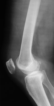 X-ray image of knee joint, lateral view, shows knee osteoarthritis (OA) 