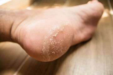 heel disease close up