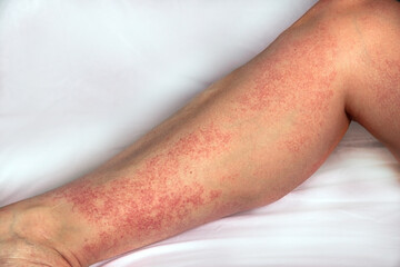 Allergic reaction on the foot