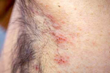 Naklejka premium Extreme close-up photography of the atocpic dermatitis symptoms on the left armpit of an adult male.