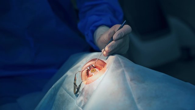Vision correction operation. Surgeon's hands in gloves performing ophtalmology operation. Modern clinic and equipment. Selective video focus on the process.