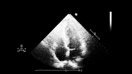 Screen of echocardiography (ultrasound) machine.