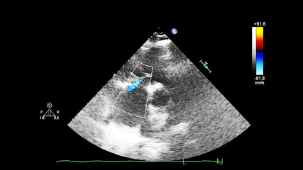 Screen of echocardiography (ultrasound) machine.