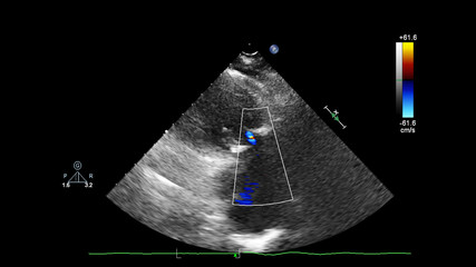 Screen of echocardiography (ultrasound) machine.