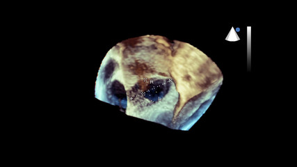 Screen of echocardiography (ultrasound) machine.